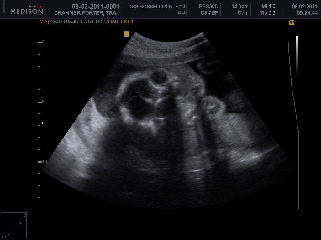 In light of her first scan showing her to be just our little peanut, here's her 24 weeks mugshot instead :)